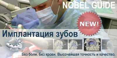 Технология Nobel Guide